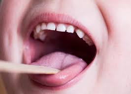 علایم 4 بیماری که نخستین بار در دهان ظاهر می شود!