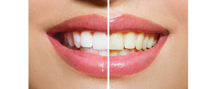 دندان‌های درخشانتر و سفیدتر می‌خواهید؟