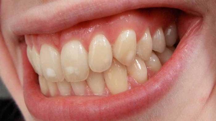 لکه‌های سفید روی دندان