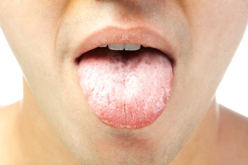 سفید شدن زبان 