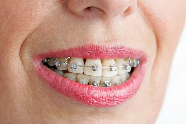 انواع روش های ارتودنسی دندان 