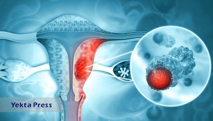 افزایش سرطان‌های ویژه زنان در ایران