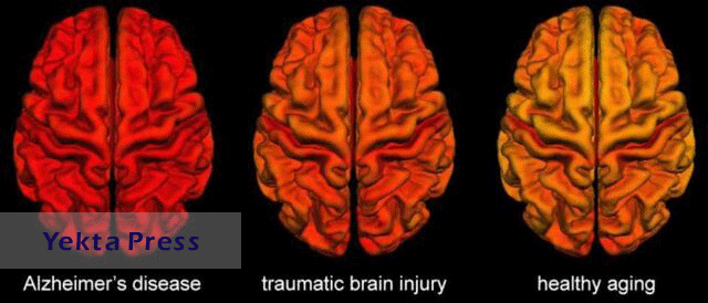 آیا آسیب‌های مغزی موجب آلزایمر می‌شود؟