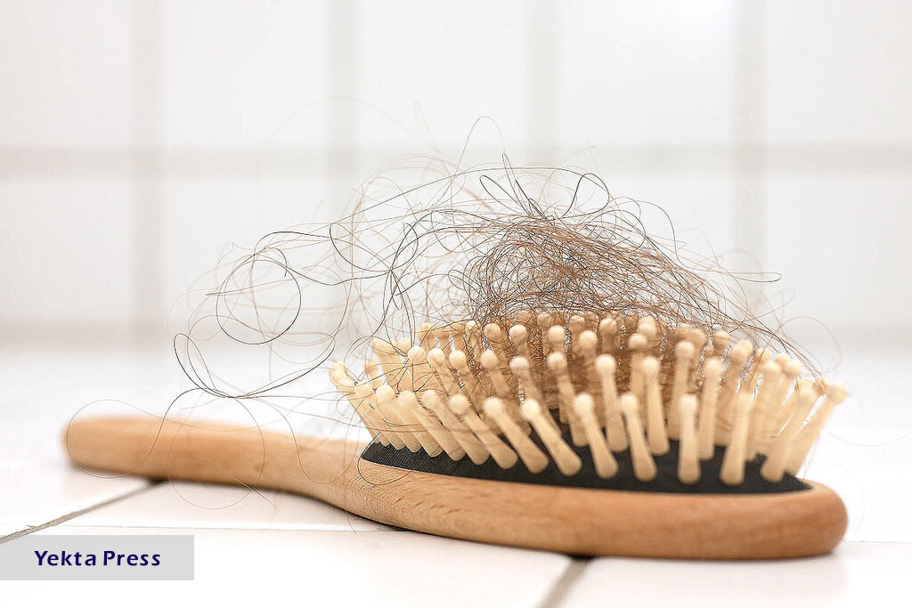 علت ریزش مو در زنان کمبود چه ویتامینی است ؟